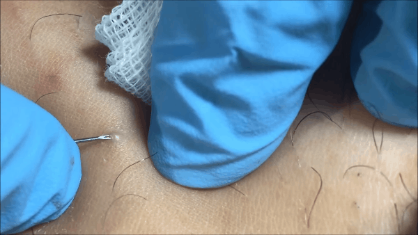 lông mọc ngược