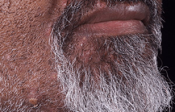 Biến chứng của bệnh lông mọc ngược Biến chứng của bệnh lông mọc ngược